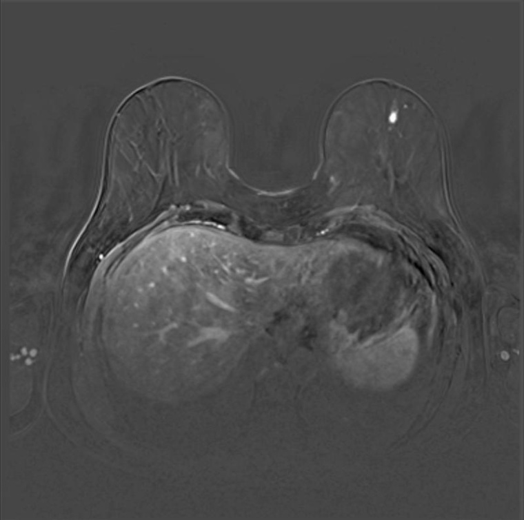 Frühzeitige Detektion eines kleinen (8 mm) Mammakarzinoms der linken Brust bei...