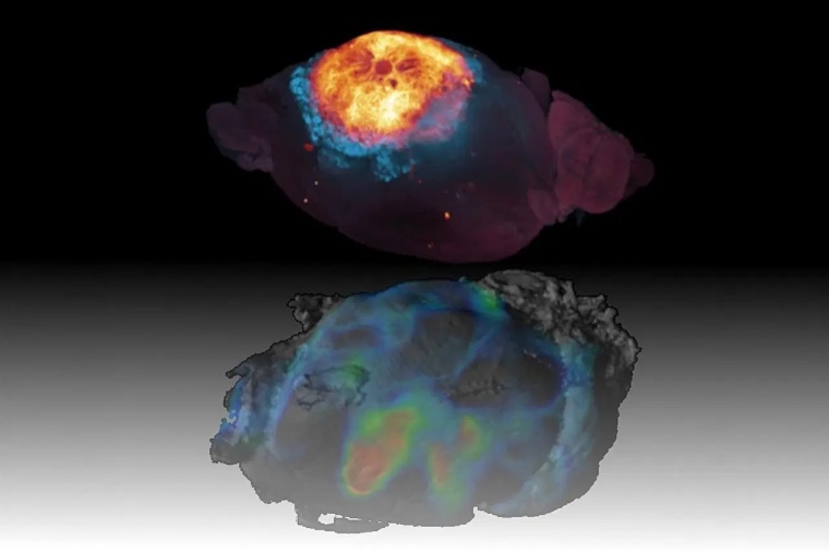 3D-Histologie eines Glioblastoms im Gehirn der Maus (oben) und die gespiegelte,...