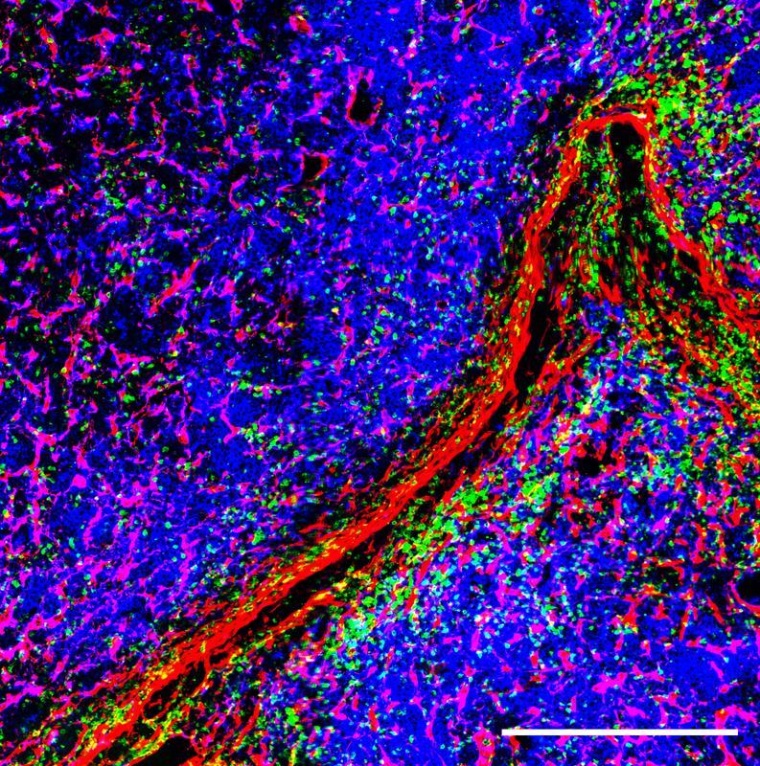 Immunfluoreszenz-Bild von einer extramedullären Läsion des Multiplen Myelom,...