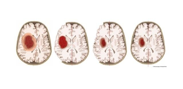 Um schwere Druckschäden nach einer Hirnblutung zu verhindern, haben die...