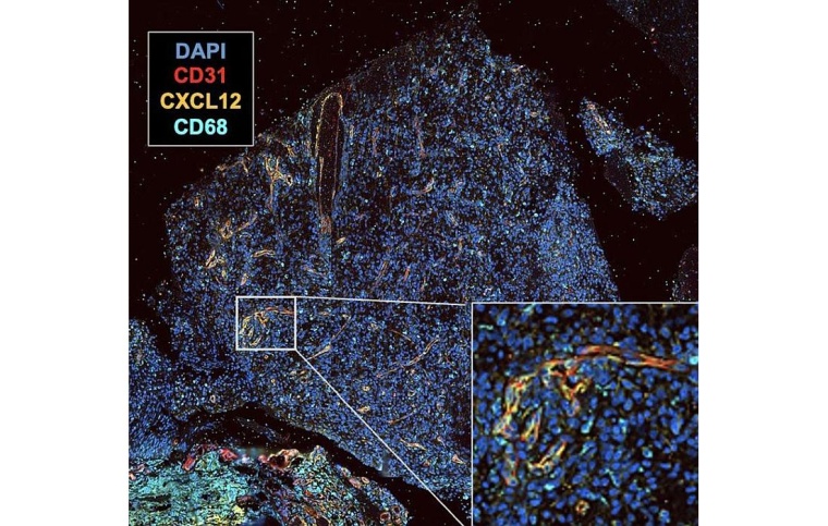 Dargestellt ist ein Gewebsstück eines Glioblastoms. Die Gefäße sind rot, der...