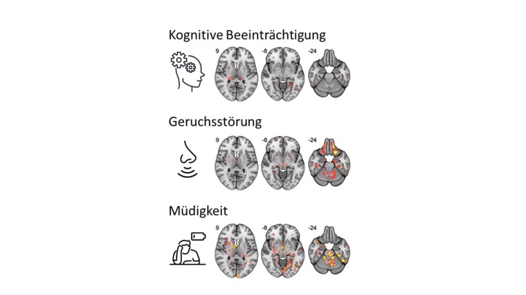 Nach einer Infektion mit COVID-19 besteht ein Zusammenhang zwischen einer...