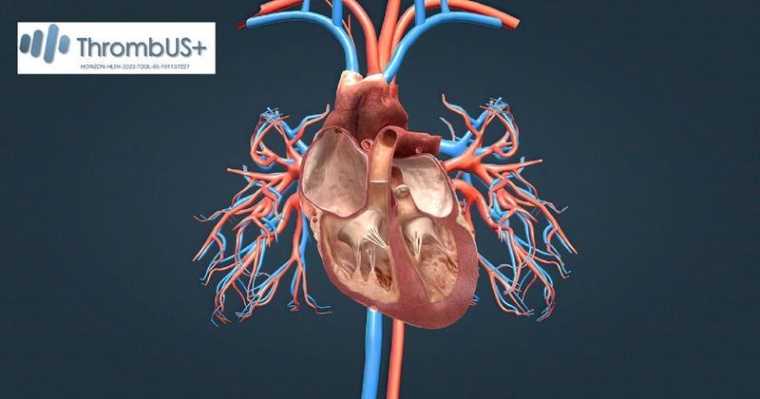 Darstellung einer Lungenembolie, einer potenziell tödlichen Komplikation durch...
