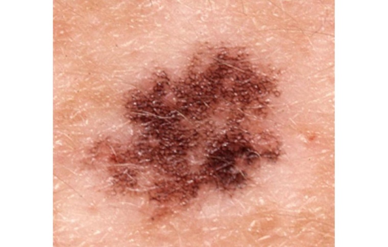 Abbildung eines Melanoms beim Menschen. Foto: Reinhard Dummer,...