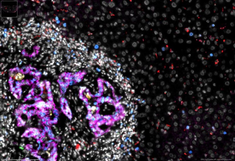 Ein Darmkrebsableger (linke Bildhälfte) in der Leber. In Magenta sind...