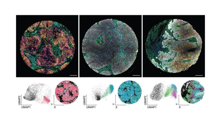 Patientenbiopsien wurden mit fluoreszierenden Antikörpern gefärbt. Die...