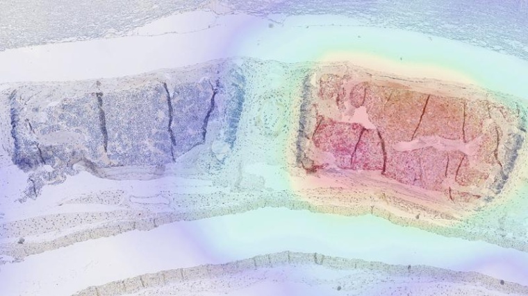 In der rechten Hälfte dieses Gewebeschnitts attackieren modifizierte...