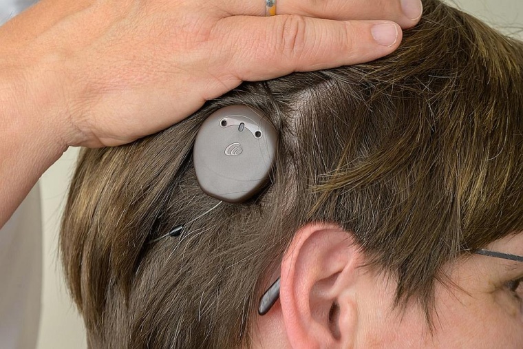 Kaum sichtbar unter den Haaren: Der Sprachprozessor wird mithilfe eines...