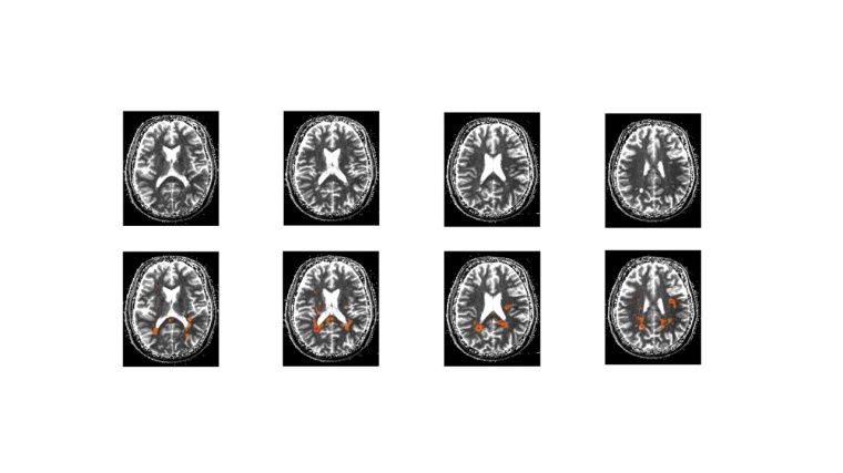 Obere Bildreihe: Vier Protonendichte-gewichtete MRT-Aufnahmen des Gehirns eines...